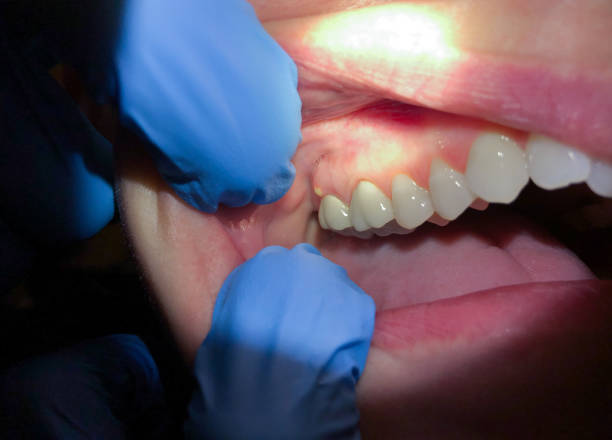 Best Dentist for Tooth Abscess  in Bohners Lake, WI