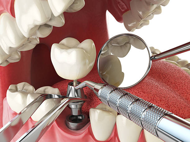 Best Knocked-Out Tooth Emergency  in Bohners Lake, WI